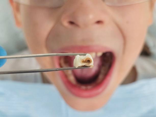 Best Emergency Wisdom Teeth Removal in Wauchula, FL