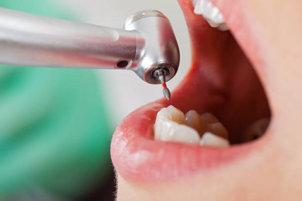 Best Emergency Treatment for Dental Infections or Abscesses in Wauchula, FL